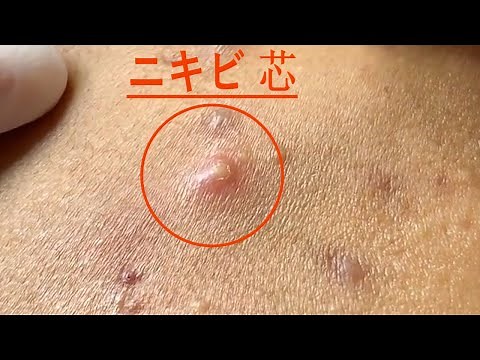 黒角栓, ニキビ 芯出し