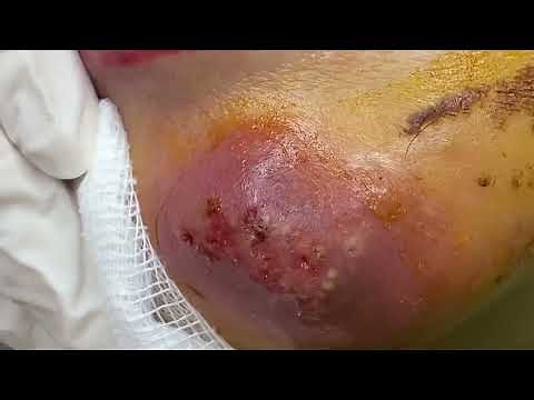 acne infectionpoor 65 year old Oman.P2
