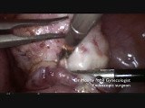 Live surgery. Safe, Fast, Bloodless Myomectomy • Video • MEDtube.net