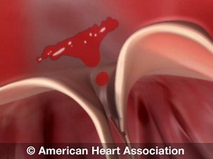 Problem: Tricuspid Valve Regurgitation