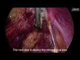 The Imbalance of Pelvic Forces and the Pain Caused By Endometriosis: En Bloc Peritonectomy, a Solution for This • Video • MEDtube.net