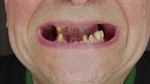 A Man Shows His Rotten Teeth.close-up Toothless Mouth of an Elderly Man. Stock Footage - Video of loss, medical: 184767680