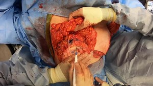 Central Mound Breast Reduction