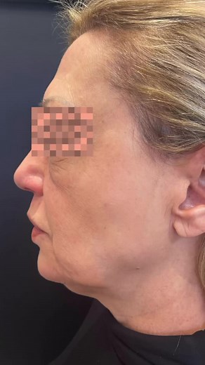 🙋‍♀️ Este tratamiento lo hicimos con 👉🏻 Radiesse (Hidroxiapatitacalcica)Realizamos 👇🏻🍃Bio estimulación🍃Mini lifting 🍃Contorno Mandibular 🍃Surcos de marioneta 🌿Tratamiento ambulatorio y sin cirugía .🙌🏻 Resultados de #antesydespues , realizado por la Dra Sofía Avramovic (@dra.sofiaavramovic ).❓ Tenes dudas ? Envíanos tu mensaje por 👇🏻. 🌿Flebologia & EstéticaDres Avramovic🏥 Av Santa Fe 1753 Pb ( única dirección en Recoleta)#medicinaestetica #bellezaysalud #acidohialurónico #toxinabo