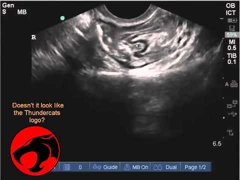 Pelvic pain diagnosis - intussusception