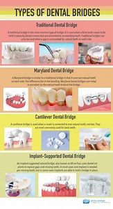 Dental Bridges in Baltimore MD | Replace Missing Teeth