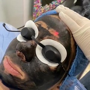 Carbon peeling session (Hollywood peel) White Friday Offers are...