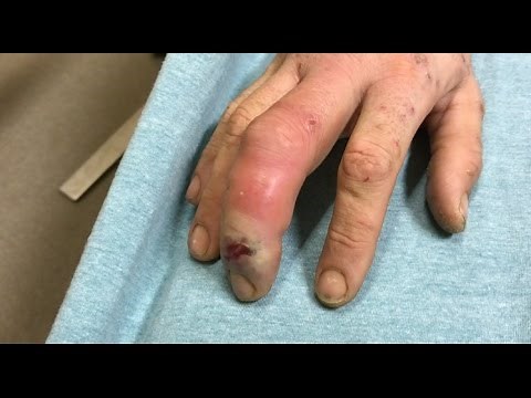 severe finger infection