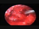 Endoscopic Tympanomastoidectomy with Soft Tissue Reconstruction • Video • MEDtube.net
