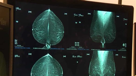 Woman's Doctor: New technology enhances mammogram imaging