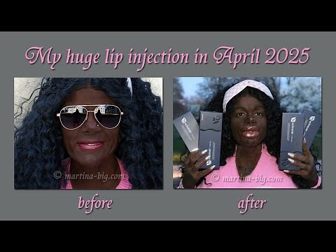 Malaika Kubwa - Martina Big - Lip augmentation April 2025 Trailer
