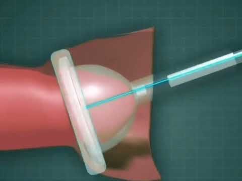 Exploring adult circumcision: a step-by-step medical animation