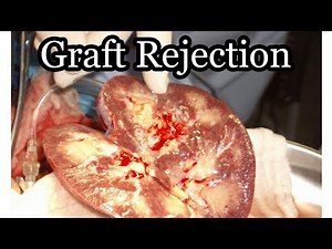 Graft Rejection || Mis.Medicine