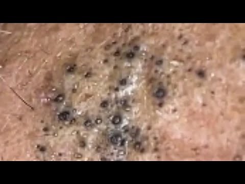 Extraction de POINT NOIRS en profondeur