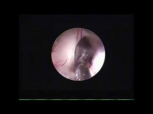 3rd ventricular colloid cyst
