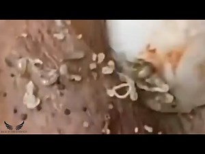 Elderly Blackhead Removal - Cystic Acne - Whitehead Removal - Relaxing Facial Spa Treatment | #139