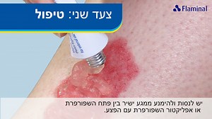 ▶️צפו במדריך הווידיאו החדש שלנו לשימוש עצמי בפלאמינל (Flaminal): ניתן להשתמש בפלאמינל לאורך כל שלבי ריפוי הפצע. | Gamida