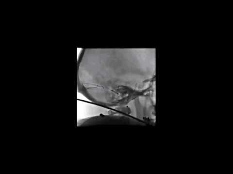 Venous stenting with concurrent ICP monitoring for the treatment of pseudotumor cerebri