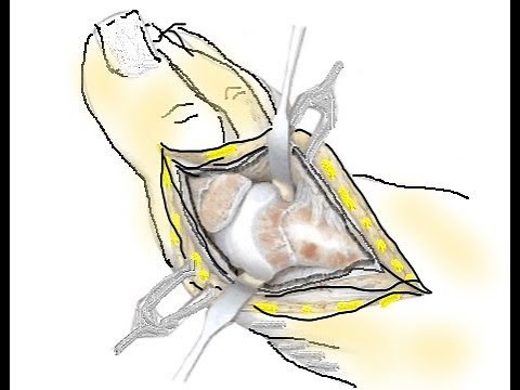 Medial Approach to the Metatarsophalangeal Joint of the Great Toe .