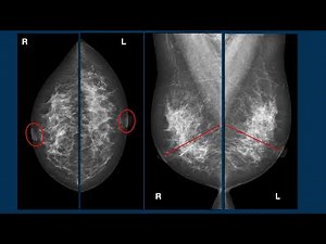 CASE 1 SMALL BREAST: from image to positioning error correction, CC projection