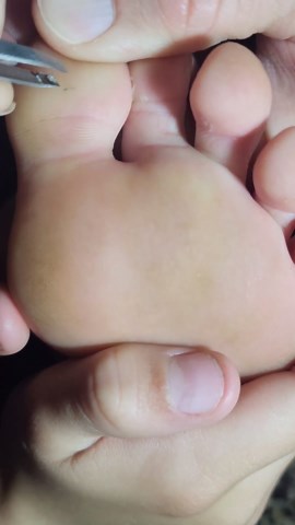 the full life crew: splinter removal from toe