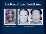 Images of Holistic Hypothyroidism Solutions