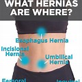 Female Hernia Symptoms in Groin