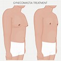 Gynecomastia Stages