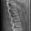 LS Spine AP and Lateral View