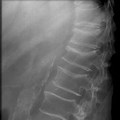 LS Spine Osteoporosis X-ray