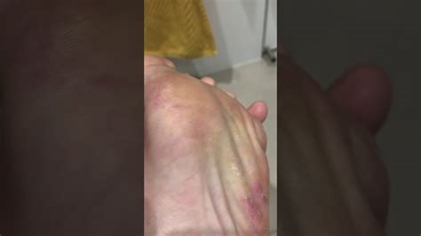 athlete's foot scratcher nude