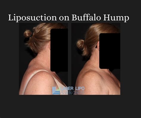 buffalo hump reddit nude