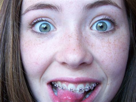 can i suck dick with braces nude