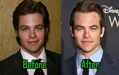 chris pine lip injections nude