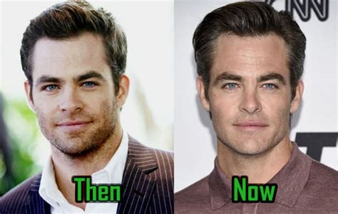 chris pine lip injections nude