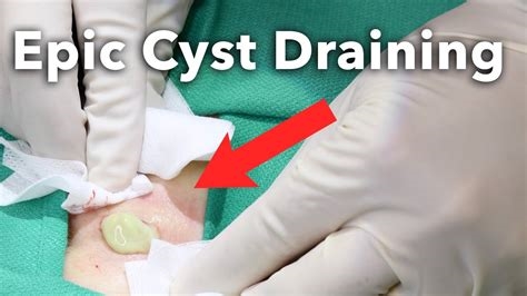 how to drain a pilonidal cyst yourself reddit nude