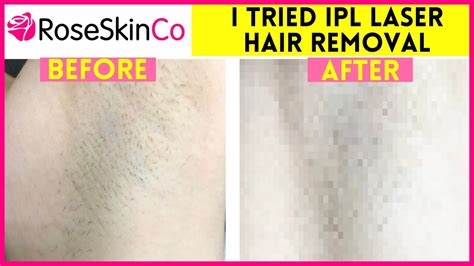 ipl hair removal reddit nude