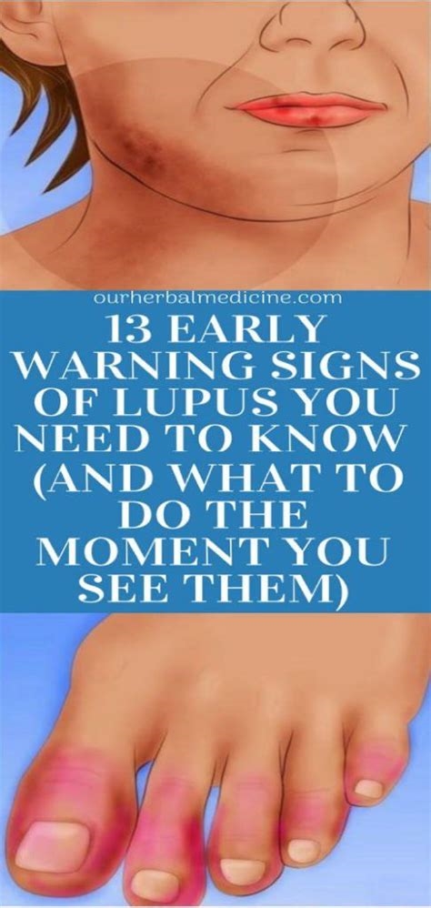 lupus wellness nude