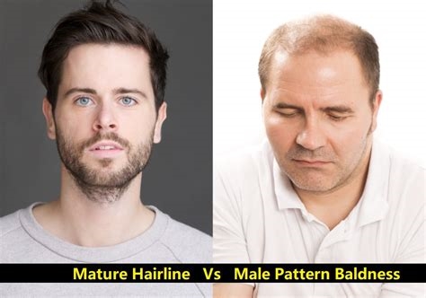 mature hairline vs receding reddit nude