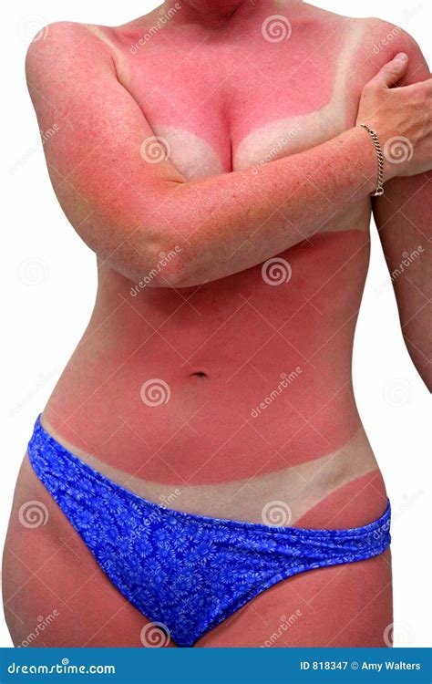 sunburnt nude nude