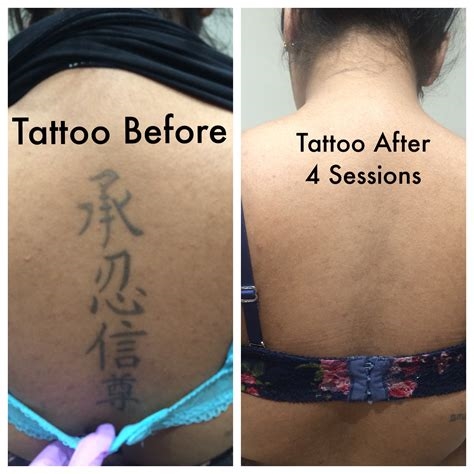 tattoo removal porn nude