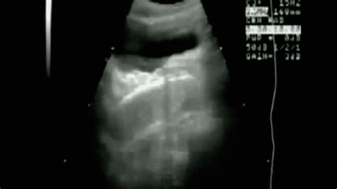 ultrasound xxx nude