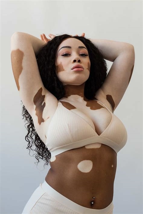 vitiligo nude women nude
