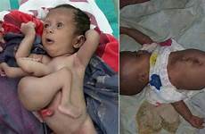 baby born parasitic twin limbs removed extra foxnews has twins parasite liver attached article her before