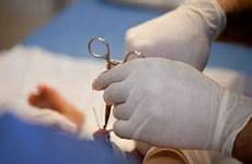 circumcision cut male unkindest penile cancer know hypocrites reduce williams