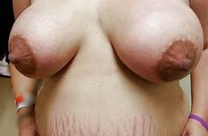 stretch marks scars women big xhamster tits scar nipples amateur nippled