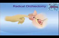 orchiectomy orchidectomy bilateral