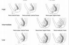 anus male diagram imperforate fistulas female internal fistula various open schematic presented results figure policy copyright access