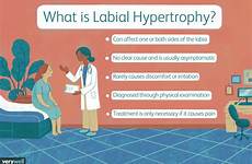 causes labia enlargement hypertrophy labial treatment nez verywell riaz verywellhealth