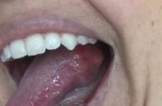 tongue cancer bump mediadrumworld bite powell aggressive